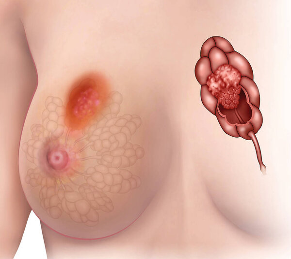 Tumor in the breast lobules