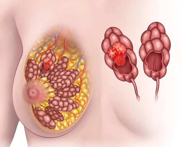 Ilustración descriptiva del cáncer de lóbulo mamario . — Foto de Stock