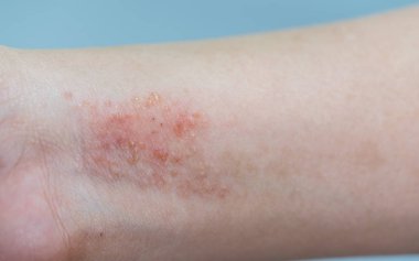 atopic dermatitis symptom skin clipart