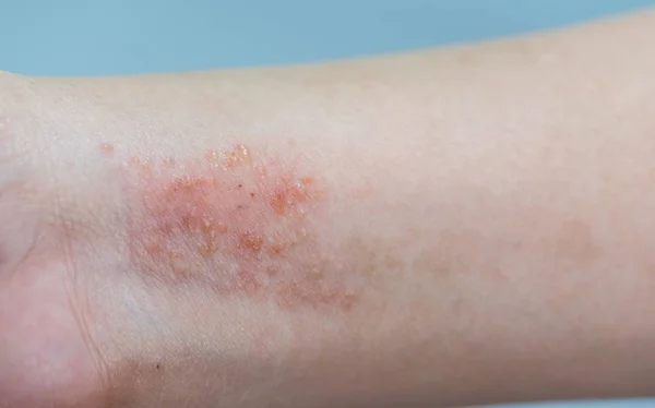 Симптом атопического дерматита кожи — стоковое фото