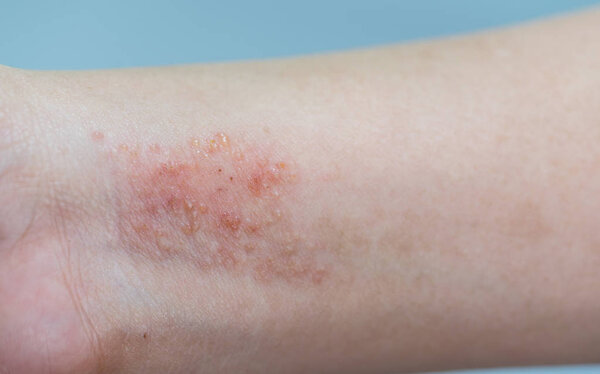 atopic dermatitis symptom skin
