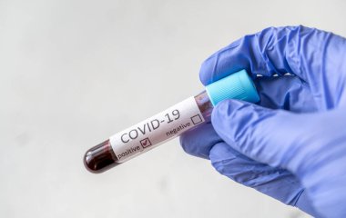 COVID-19 testi için kan örneğiyle birlikte test tüpü. Pozitif test.