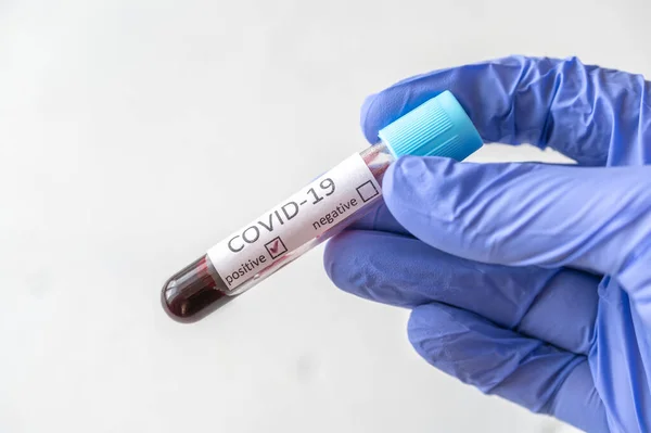 Zkušební Zkumavka Vzorkem Krve Pro Test Covid Pozitivní Test — Stock fotografie