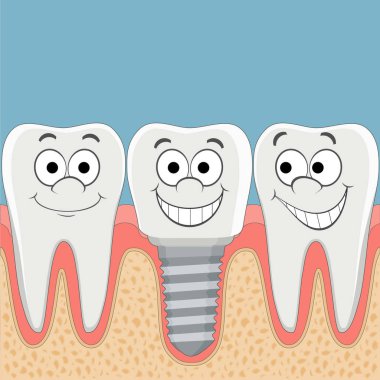 İnsan dişleri ve Dental implant.
