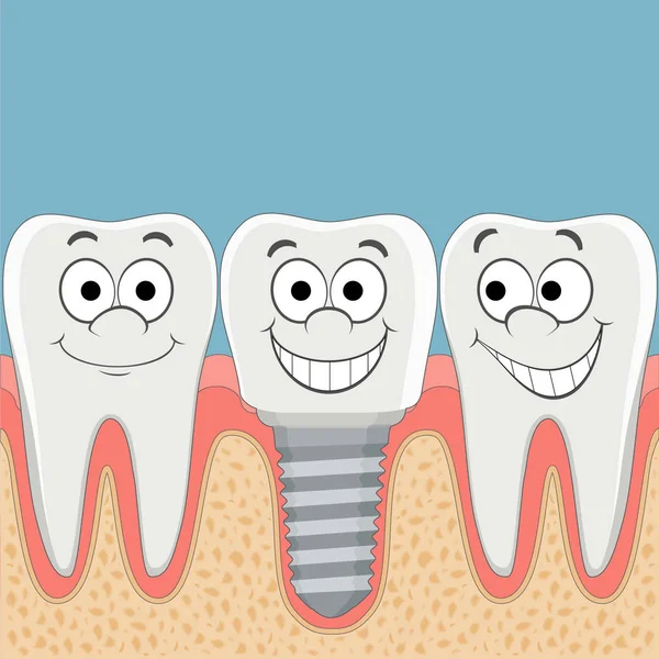 Human teeth and dental implant. — Stock Vector