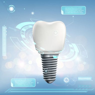 İnsan Dental implant.
