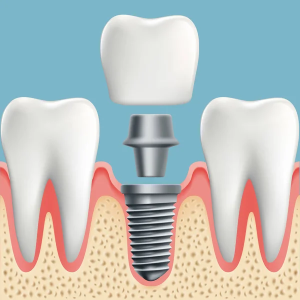 İnsan dişleri ve Dental implant — Stok Vektör