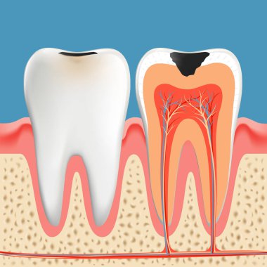 Diş çürüğü anatomi posteri. Enamel ve Dentin Caries