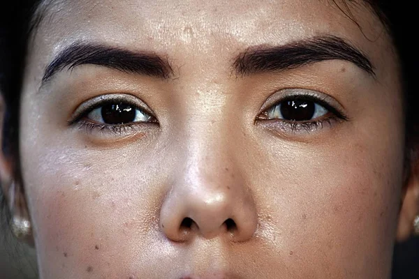 समस्या त्वचा स्थिती किंवा फ्रेकल्ससह चेहरा — स्टॉक फोटो, इमेज