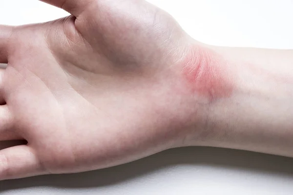Syndrome de bureau concept de blessure au poignet Syndrome du canal carpien — Photo