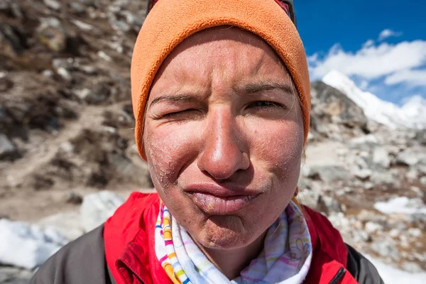 Trekker with burned skin on face is smiling at camera in Khumbu — Stock Photo, Image