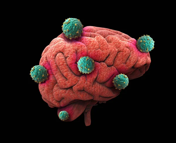 Cáncer Cerebral Humano Con Células Que Diseminan Crecen Como Células — Foto de Stock