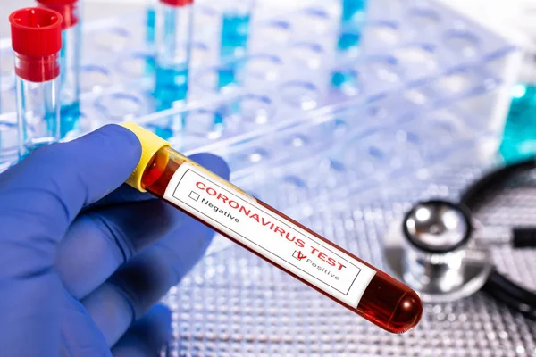 Hastane Laboratuvarında Coronavirus Kan Testi — Stok fotoğraf