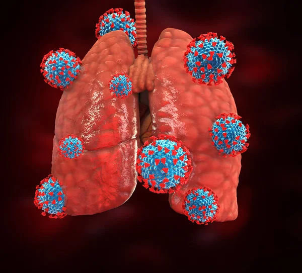 Coronavirus Covid Bulaşıcı Enfeksiyon Salgını Akciğerlere Saldırır — Stok fotoğraf