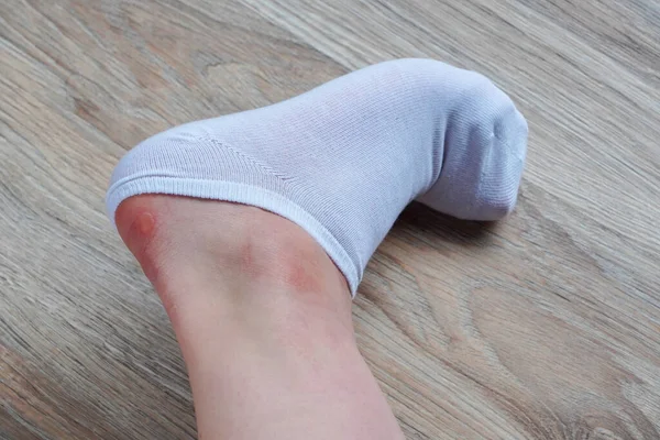 Water corns on heels of woman in white socks, RUB the calluses with new shoes. grated bloody blown callus on the foot on skin. First aid, Naked foot with painful Heel