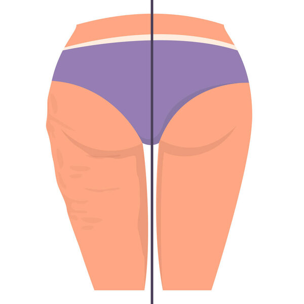 Cellulite on the hips vector isolated. Before and after, female