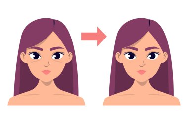 Blepharoplasty vektör izole edilmeden önce ve sonra. Tıbbi operasyon, kadın yüzü modifikasyonu. Göz kapağından estetik ameliyat. Kırışıklıklardan kurtul..