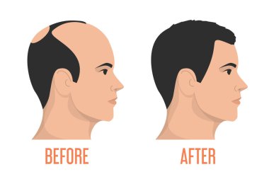 Hait nakli vektör izole edilmeden önce ve sonra. Alopecia tedavisi, kelliği unut. Kılsız adam..