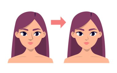 Rhihoplasti öncesi ve sonrası. Burun düzeltmesi, ameliyattan sonra kadın karakter. Tıbbi prosedür.