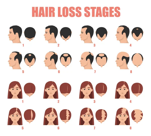 脱毛ステージベクトル絶縁 女性と男性の脱毛症 バランスのとれたプロセスのセット 髪のない女と男の頭 — ストックベクタ