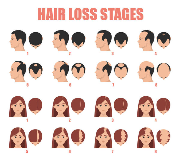 Hair loss stages vector isolated. Female and male alopecia. Set of balding process. Hairless woman and man heads.