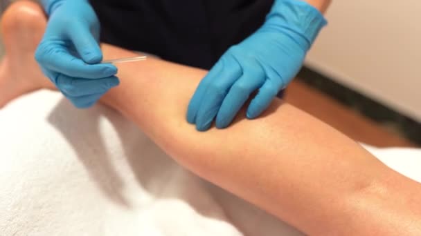 Hands of physiotherapist doing a dry needling — Stock Video