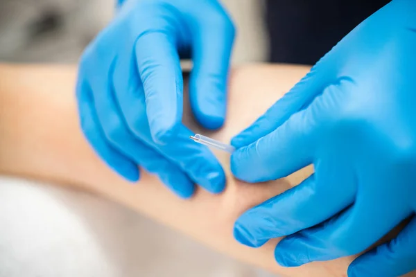 Hands of physiotherapist doing a dry needling — Stock Photo, Image