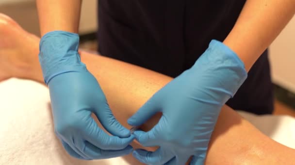 Hands of physiotherapist doing a dry needling — Stock Video