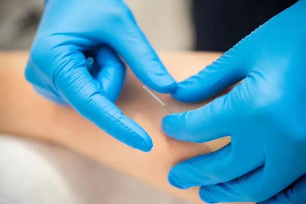 Hands of physiotherapist doing a dry needling — Stock Photo, Image