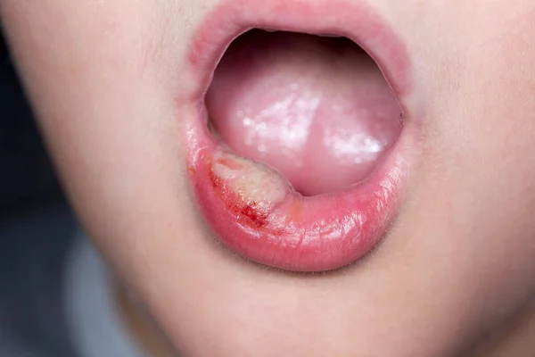 Menino doente com grande neblina em seus lábios — Fotografia de Stock