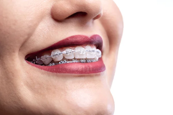 Close up of a pretty smile with braces — 스톡 사진