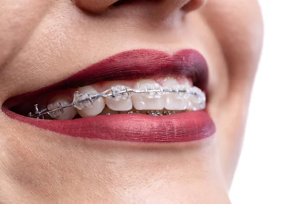 Close up of a pretty smile with braces — Stockfoto