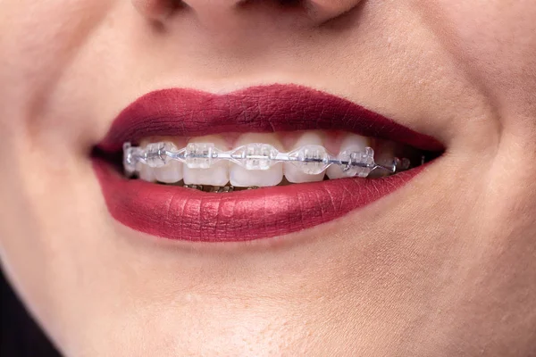 Hermosa sonrisa, dientes y frenos — Foto de Stock