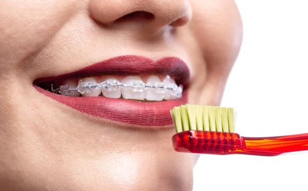 Primer plano de los dientes blancos con aparatos ortopédicos —  Fotos de Stock