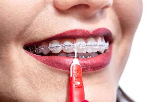 Maintaining oral hygiene and keeping braces clean — Stock fotografie