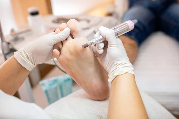 Tratamiento Pedicura Pie Área Piel Del Dedo Gordo Del Pie — Foto de Stock