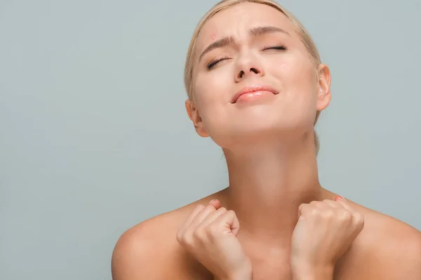 Boos Naakt Vrouw Met Acne Gezicht Geïsoleerd Grijs — Stockfoto