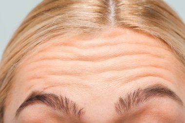 close up of forehead with wrinkles of woman  clipart