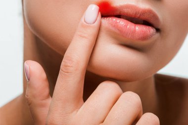 cropped view of woman pointing with finger at lips with herpes isolated on white  clipart