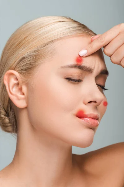 Displeased Naked Girl Touching Face Red Pimples Isolated Grey — Stock Photo, Image