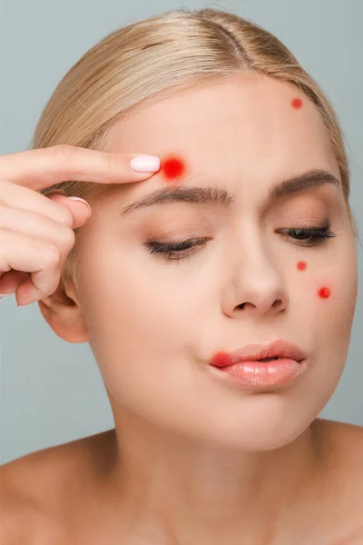 Menina Descontente Tocando Rosto Com Espinhas Vermelhas Isoladas Cinza — Fotografia de Stock