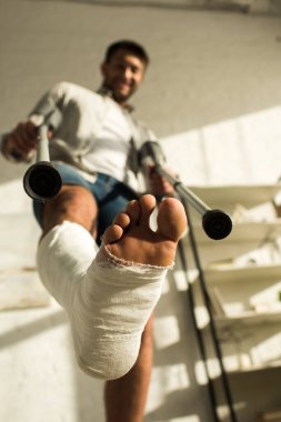 Low angle view of man with leg in plaster bandage holding crutches and smiling at camera