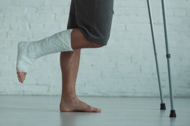 Side view of man with leg in plaster bandage holding crutches