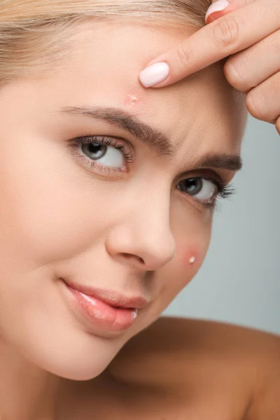 Gros plan de fille mécontente touchant le visage avec l'acné isolé sur gris — Photo de stock