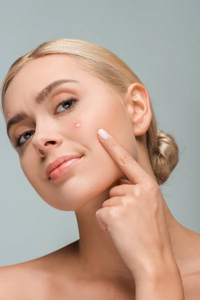 Displeased girl pointing with finger at face with acne isolated on grey — Stock Photo