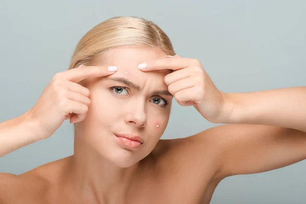 Displeased girl pointing with fingers at face with acne isolated on grey — Stock Photo