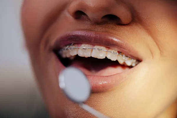 Primer plano de la mujer afroamericana feliz en frenos cerca del espejo dental - foto de stock