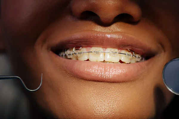 Primo piano di felice donna afro-americana in apparecchio vicino strumenti dentali — Foto stock