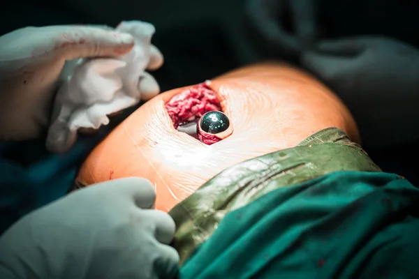 Processo di intervento chirurgico traumatico. artroplastica totale dell'anca con fissazione cementizia dei componenti — Foto Stock
