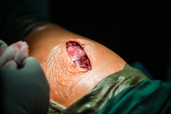 Process of trauma surgery operation. total hip arthroplasty with cement fixation of components.The thigh is set. The endoprosthesis is stable